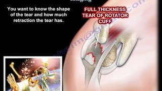 Rotator Cuff tear Imaging  Everything You Need To Know  Dr Nabil Ebraheim [upl. by Nesiaj]