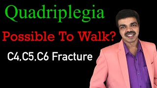 How To Cure Quadriplegia Dr s girish senior physiotherapistquadriplegia treatment [upl. by Georgy]