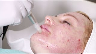 Hyaluronic acid mesotherapy and microneedling with vitamins [upl. by Dominy]