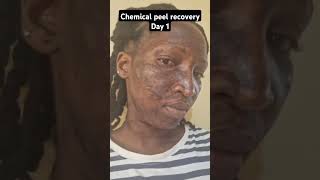 Chemical Peel Recovery  Day 1 [upl. by Sobmalarah953]