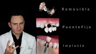 Puentes vs Implantes  ¿Cuál es la mejor opción  Dentista en Querétaro [upl. by Adlesirc]