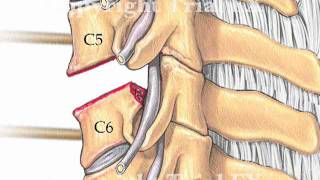 Anterior Cervical Discectomy and Disc Arthroplasty [upl. by Sieracki836]