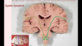 Spastic dysarthria  samples and tutorial [upl. by Anahsahs]