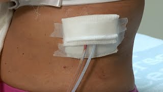 How to care for a postsurgery wound drainage system and gauze dressing [upl. by Ahsitan700]