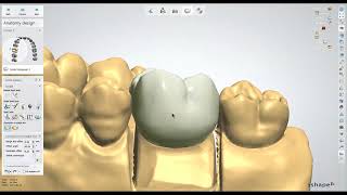 Dental Lab Life Designing a Crown in 3Shape [upl. by Waxler888]