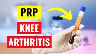 Knee PRP injection live procedure  Platelet Rich Plasma for Knee Arthritis  Dr Rohan Vakta [upl. by Sauder]