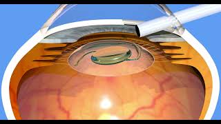 Premium Lens Implantation after Cataract Surgery IOLs [upl. by Onitnerolf]