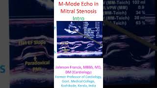 MMode Echo in Mitral Stenosis [upl. by Akirea]