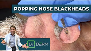 Popping Nose Blackheads  Dr Derm [upl. by Aihsekel]