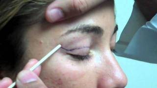 Dr Jeffrey Epstein  MarkUp for Upper Eyelid Blepharoplasty  Female Patient [upl. by Solram]