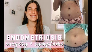 ENDOMETRIOSIS  my surgery  diagnosis experience [upl. by Pirozzo950]