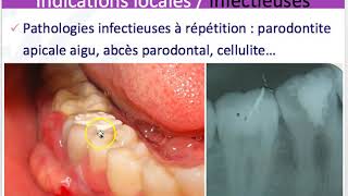 Indications et contre indications des extractions dentaires [upl. by Parker]