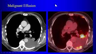 3b Lung Cancer P2 [upl. by Velick]