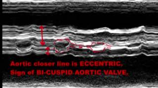 BICUSPID AORTIC VALVE  ECHOCARDIOGRAPHY SERIES BY DR ANKUR K CHAUDHARI [upl. by Uase]