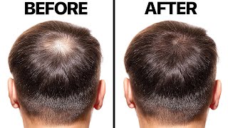 Minoxidil for Hair Loss [upl. by Haroldson987]