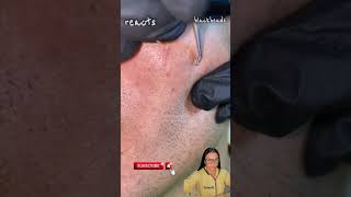 blackheads nose blackheads removal satisfying blackheads removal lips blackheads removal ear [upl. by Niwrud]