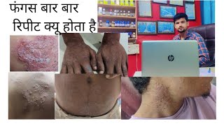 फंगस गजकरण खुजली बार बार रिपीट क्यू होता हैfungal infection reason [upl. by Conger]