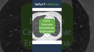 🔍 CT Scans Unveiled Centrilobular Emphysema Emphysema Radiology usmle copd [upl. by Nylle]