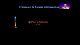 28 Evaluación de fístulas para hemodiálisis  Dr Francolin [upl. by Haron]