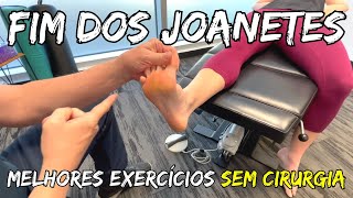 Melhores Exercícios para JOANETES Sem Cirurgia [upl. by Orimisac]