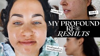 Profound Radio Frequency® Skin Tightening  my results 1 year later [upl. by Calore]