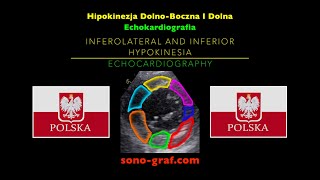 Echokardiografia  Hipokinezja DolnoBoczna I Dolna [upl. by Idnyc231]