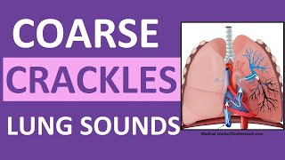 Crackles Coarse Lung Sounds  Crackles and Rales Breath Sounds Abnormal [upl. by Droffats]