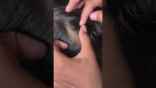 lice treatment headlicetreatment licecomb [upl. by Cozza111]