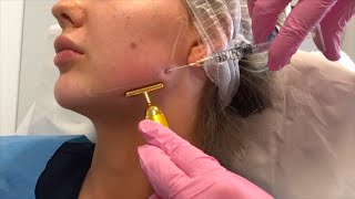 Jawline Filler London  by Dr Leah Totton [upl. by Yemrots]