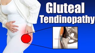 Gluteal Tendinopathy Symptoms Causes and Effective Exercises for Greater Trochanter Pain [upl. by Esille]