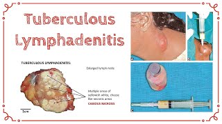 TUBERCULOUS LYMPHADENITIS  Stages Of TB Lymphadenitis  Cold Abscess  General Surgery [upl. by Field54]