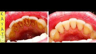 COMMENT DÉTARTRER LES DENTS A LA MAISON POUR AVOIR DES DENTS PROPRES AVEC CETTE RECETTE FACILE👍😀 [upl. by Brownley]