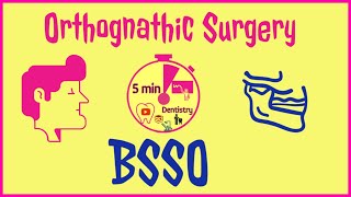 BSSO  BILATERAL SAGITTAL SPLIT OSTEOTOMY  ORTHOGNATHIC SURGERY  5 min DENTISTRY easy notes [upl. by Ob885]