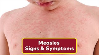 The 3 Warning Signs of Measles To Look Out For  How To Spot Measles Rash [upl. by Wallraff]