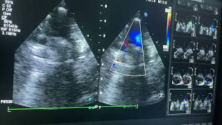 Truncus arteriosus  tricuspid valve attesia [upl. by Anisamot626]