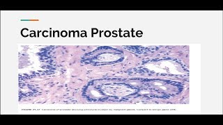 Carcinoma prostate [upl. by Amsaj366]