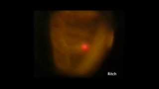 Argon Laser Peripheral Iridoplasty ALPI The BEST VIDEO Robert Ritch MD [upl. by Arahd]