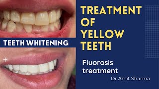 How dentist make yellow teeth white  Teeth whitening  Fluorosis treatment [upl. by Nessaj]