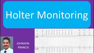 Holter Monitoring [upl. by Herr]