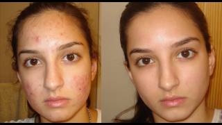 A true miracle How I got rid of my acne Daily skincare routine [upl. by Noyad802]