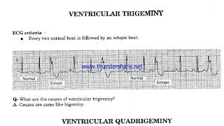 Ventricular Bigeminy Trigeminy amp Quadrigeminy [upl. by Hahseram]