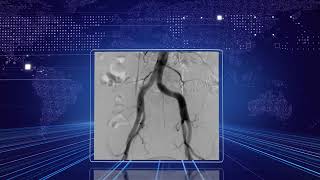 Mobile interventional Carm system PLX7100A DSA vascular ERCP Genecology angiography fluoroscopy [upl. by Herrington924]