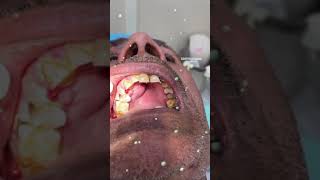 Dental abscess  extraction [upl. by Nnyllaf]