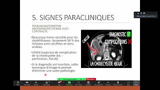 Cholécystite aigue Dr AING PITOU [upl. by Lombardy]