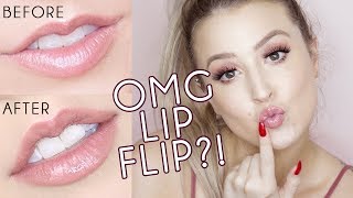 Botox Lip Flip VS Lip Filler [upl. by Swee]