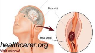 Anoxic Brain Injury [upl. by Eaned]