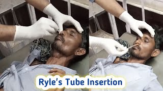 Ryles Tube Insertion Procedure 💉 Nasogastric tube Insertion hindi [upl. by O'Rourke]