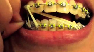 Braces Update  13 Eight Elastics [upl. by Inot]