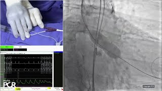 Align for the future with nextgeneration balloon expandable transcatheter heart valve technology [upl. by Nwahsek306]