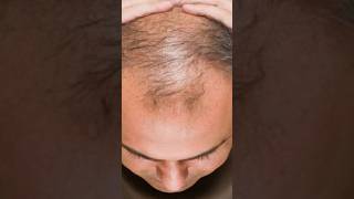 बाल झड़ना  गंजापन  calcarea carbonica Baldness  Best Homeopathic Treatment homeopathicmedicin [upl. by Jodie]